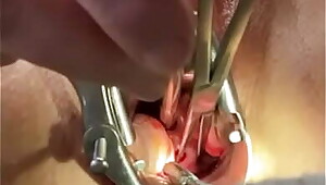 Holding cervix w tenaculum while 8mm dilator fucks uterus